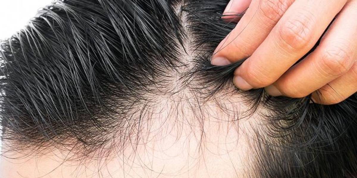 ¿Cómo regenerar el cabello en 10 días?; esta es la nueva técnica celular eficaz contra la calvicie