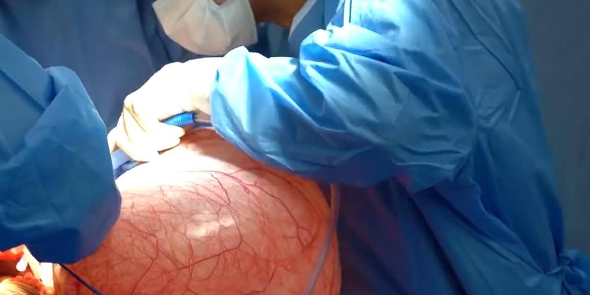Un tumor de más de 13 kilos fue extirpado de una mujer en un hospital de Guayaquil