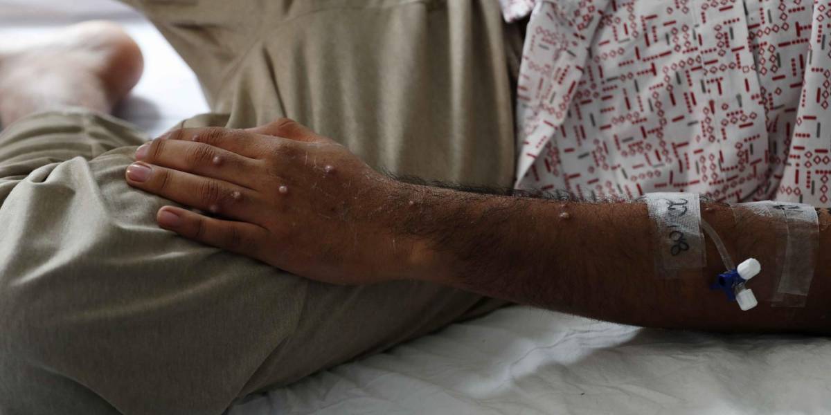 Viruela del mono | Pakistán confirma el primer caso de Mpox en Asia y alerta sobre otros dos posibles contagios