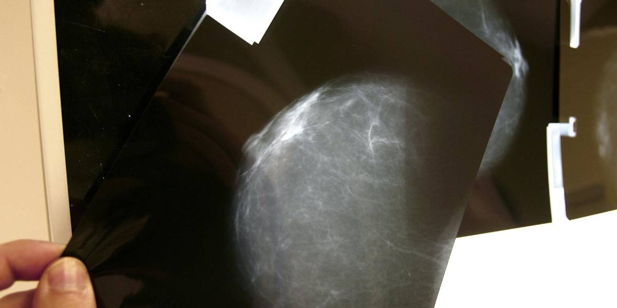 El cáncer de mama causará más de un millón de muertes en el 2050
