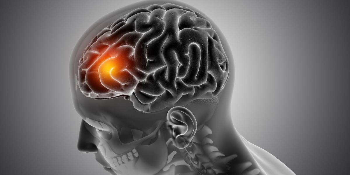 Cómo detectar a tiempo un derrame cerebral: síntomas que aparecen semanas antes