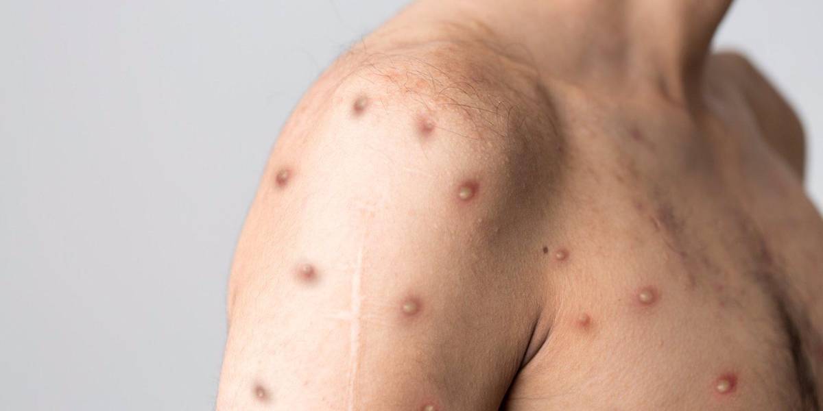 Viruela del mono: Europa ya alcanza los 16.750 casos; España lidera en el número de contagios