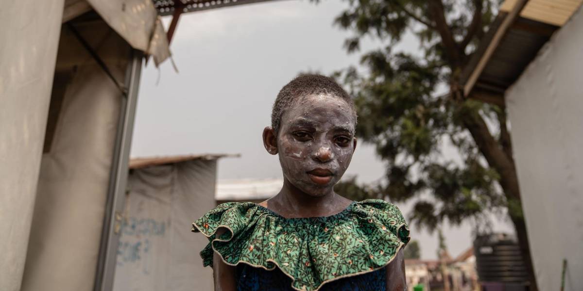 ¿Cómo lucen las ampollas de la viruela del mono en el cuerpo humano?