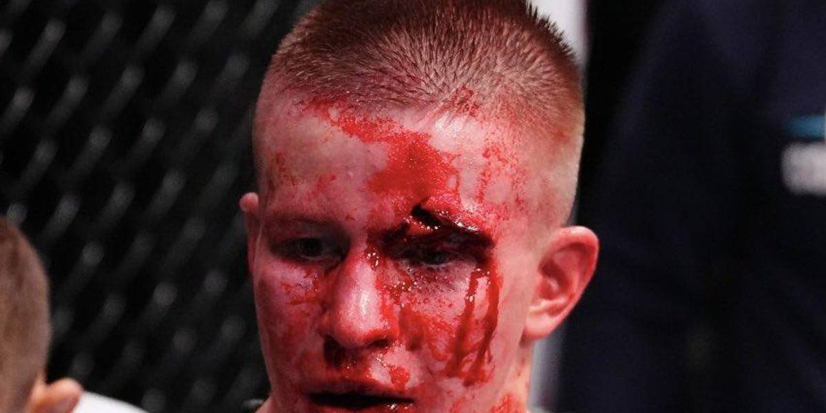 Así quedó el rostro del ruso Mark Vologdin tras perder contra Adrián Luna Martinetti en el Dana White’s Contender Series
