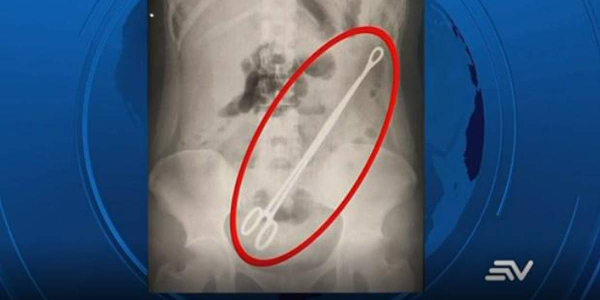 Joven en Esmeraldas tuvo una pinza dentro de su vientre durante 6 meses