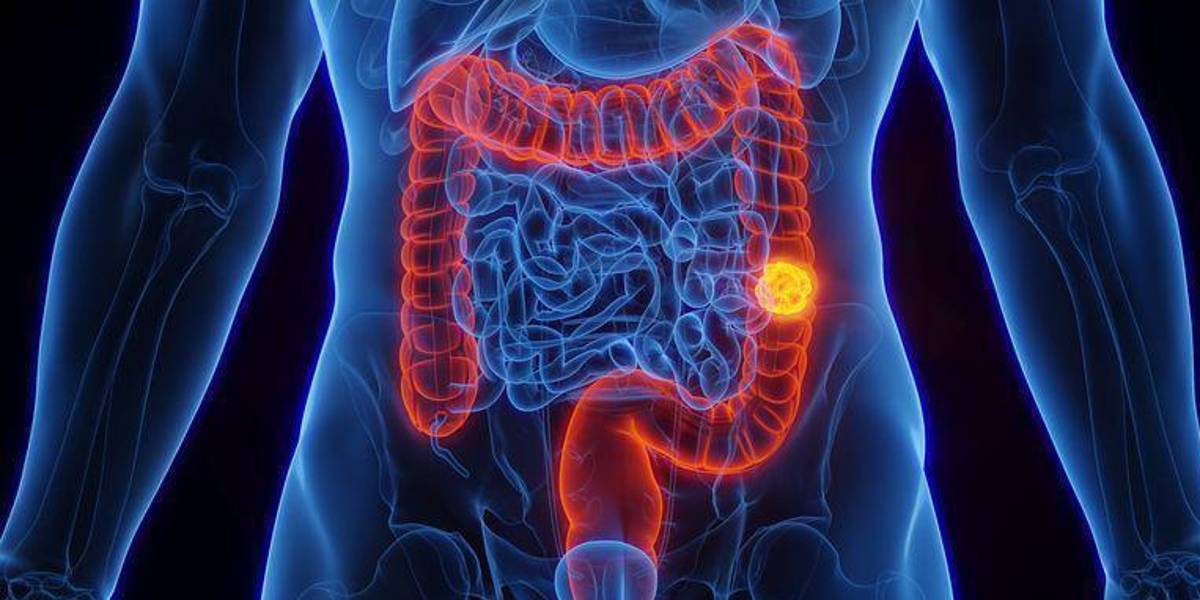Cómo se explica el aumento de los casos de cáncer colorrectal entre las personas menores de 50 años