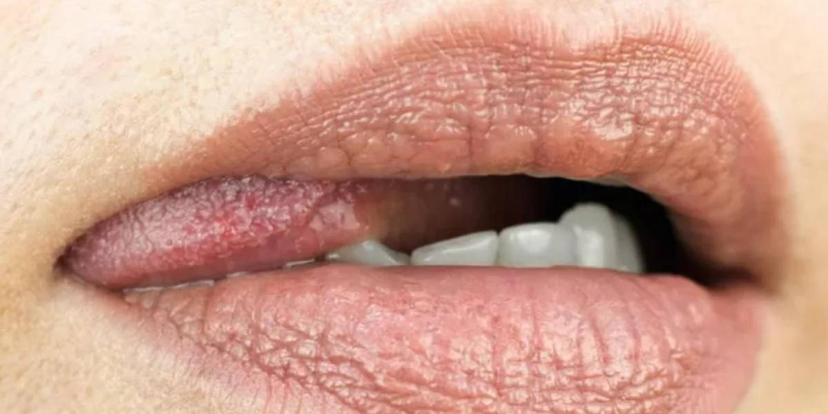 Las enfermedades que pueden transmitirse durante el sexo oral sin preservativo y cómo protegerte