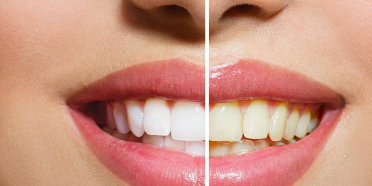 Cinco claves para mantener los dientes blancos