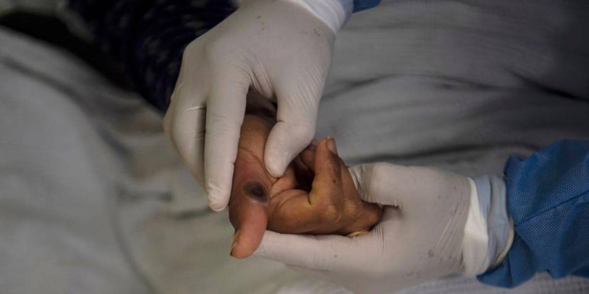 OMS levanta la emergencia sanitaria internacional por la viruela del mono