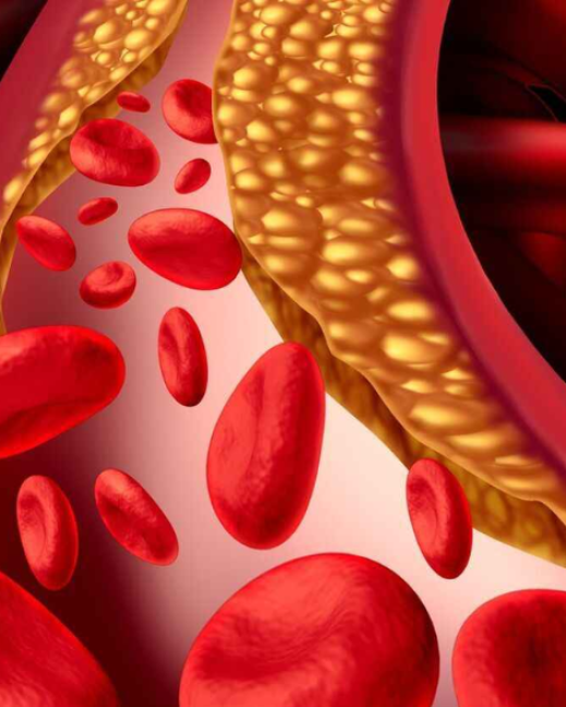 Imagen referencial. Colesterol elevado en la sangre.