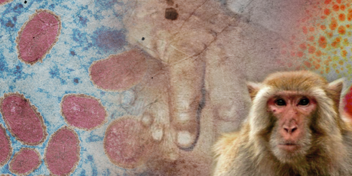 Paciente con viruela del mono y otras patologías muere en Ecuador