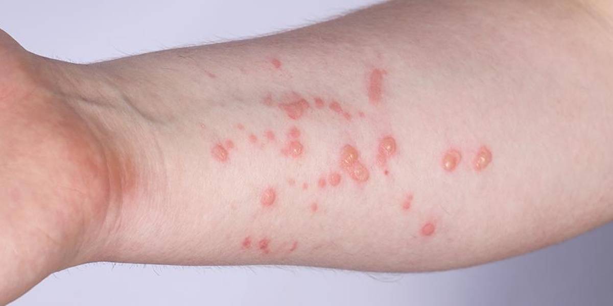 La Federación Médica Ecuatoriana y el Ministerio de Salud Pública desmienten un caso de viruela del mono en Ecuador