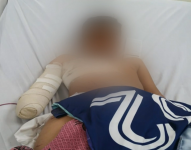 Un niño perdió su mano derecha tras manipular un explosivo que halló en un parque, en Guayaquil