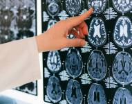 Las enfermedades cerebrovasculares son la tercera causa de muerte en Ecuador