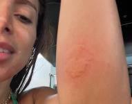 Anitta mostrando su picadudra en el brazo.