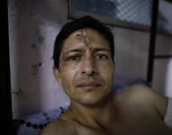 Edison Figueroa, un ecuatoriano de 29 años y sobreviviente del accidente de bus, se recupera de las heridas en un albergue católico en David, Chiriquí (Panamá).
