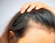 Este tipo de alopecia puede estar asociado a la inflamación generalizada que produce el virus. Referencial