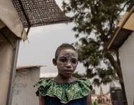 Lucie Habimana, de 13 años, tiene la cara cubierta con ungüento después de recibir tratamiento para el mpox en el Centro de Salud Munigi en Munigi, República Democrática del Congo, el 16 de agosto de 2024.