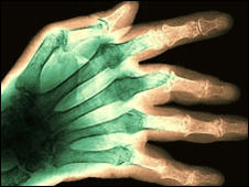 Proteína de artritis revierte el Alzheimer