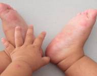 Imagen referencial que refleja el brote del virus de pies, manos y boca en niños.