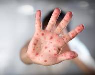 Los síntomas del sarampión aparecen, por lo general, unos 7 a 14 días después de que la persona se infecta.