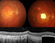 Una nueva prótesis ocular ha logrado devolver la visión a personas con ceguera irreversible a consecuencia de una atrofia geográfica, la última etapa de una forma de degeneración macular asociada a la edad (DMAE), que afecta, aproximadamente a 5 millones de personas en el mundo. Se trata de un dispositivo compuesto por dos partes, un microchip inalámbrico que se implanta en la parte posterior del ojo y unas gafas de realidad aumentada. En la imagen puede verse el microchip insertado en el ojo.