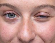 Enfermedad Miastenia Gravis