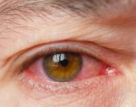 Ojo infectado con conjuntivitis.