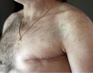 Cáncer de mama en hombres. Foto: Archivo/AP