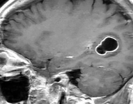 Esta imagen de resonancia magnética permite apreciar la lesión causada por la tenia del cerdo.