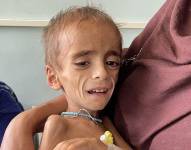 Un niño con desnutrición en Kandahar, en Octubre