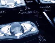El de próstata es el cuarto cáncer más padecido a nivel mundial, según la Sociedad Estadounidense de Oncología Clínica.
