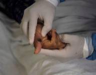 Teniendo en cuenta las dos emergencias sanitarias, desde 2022 hasta la actualidad se han confirmado en el mundo más de 150 000 casos de viruela del mono, con al menos 377 muertes.