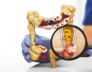 Por lo general los divertículos se desarrollan en el sigmoideo, la parte inferior izquierda del intestino grueso.