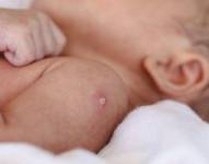 La mayoría de los vacunados con BCG experimentan una reacción en el lugar de la inyección que se considera normal y se denomina cicatriz de BCG.