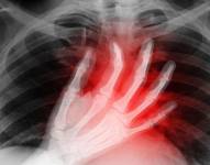 La PRN es una técnica de trasplante que ha permitido aumentar la cantidad de órganos que se pueden utilizar exitosamente.