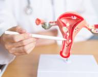 Imagen referencial: Anatomía de ovario.