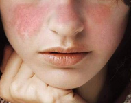 Una característica de la enfermedad es una marca en las mejillas, en forma de mariposa.