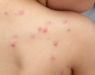 Viruela del mono en Ecuador: viajes dentro y fuera del país, lo que tienen en común los primeros dos niños infectados