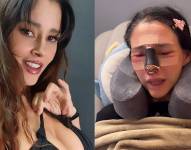 Dorismar, antes y luego de la fallida rinoplastia.