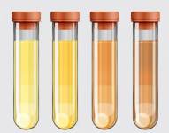 La orina puede adquirir tonos diferentes.