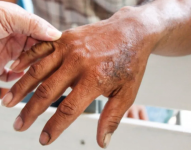 Entre 2018 y 2022 hubo 142 casos. La mayoría de personas que contrajo la enfermedad en ese periodo tenía entre 20 y 49 años.