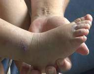 Síndrome y viruela del mono.