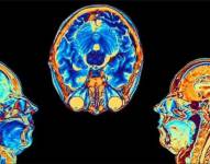 Los cambios se registraron en las zonas vinculadas al olfato y la memoria.