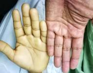 Foto referencial de personas que sufren anemia.