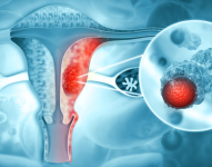 Imagen referencial. Cáncer de ovarios.