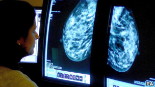 Mamografías: más beneficios que daños