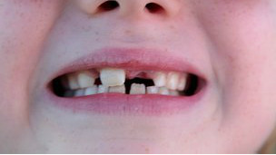 El aceite de coco combate la caries dental