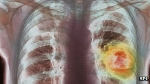 Qué tanto enferman las palomitas de maíz