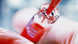 Prueba de código de barras para cáncer de próstata